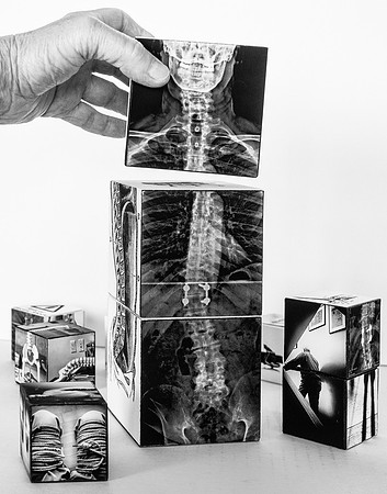 "Spine De-Reconstruction"